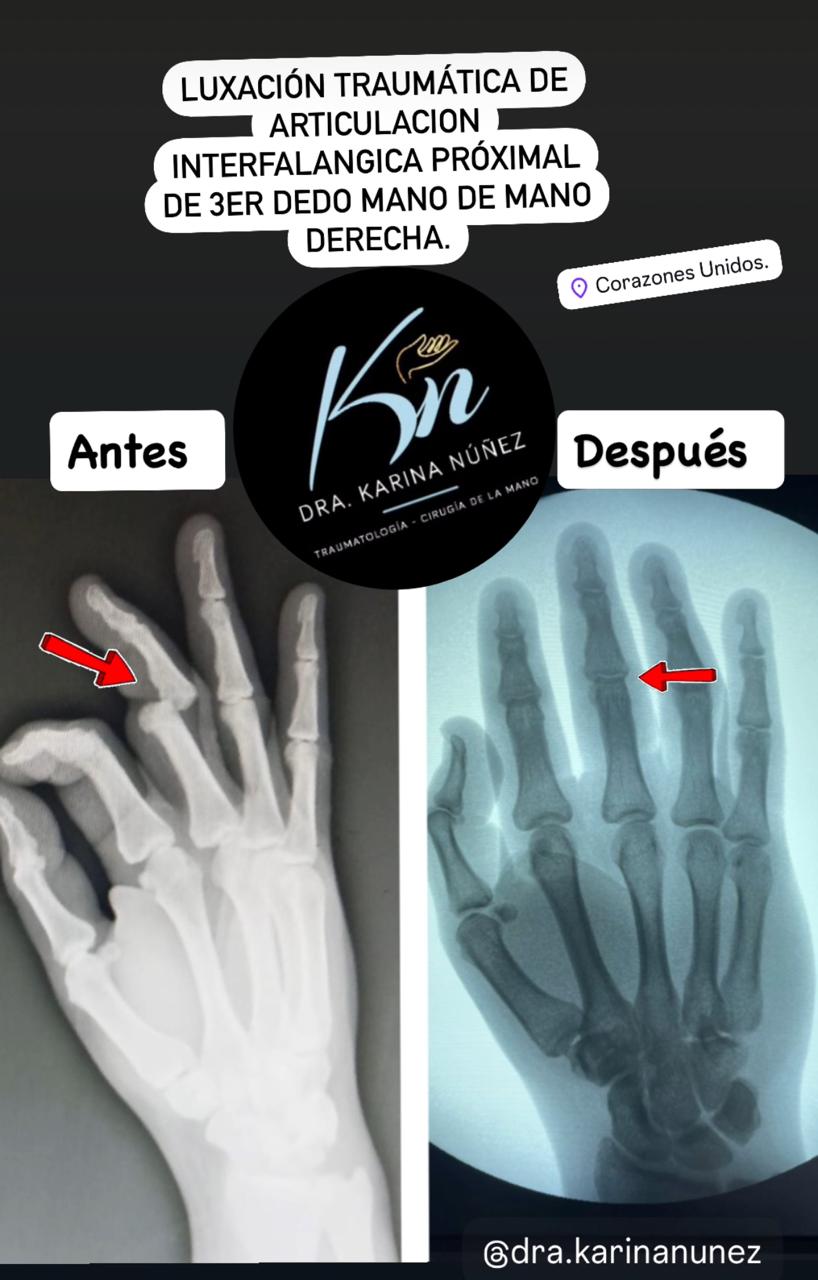 antes y despues karina2