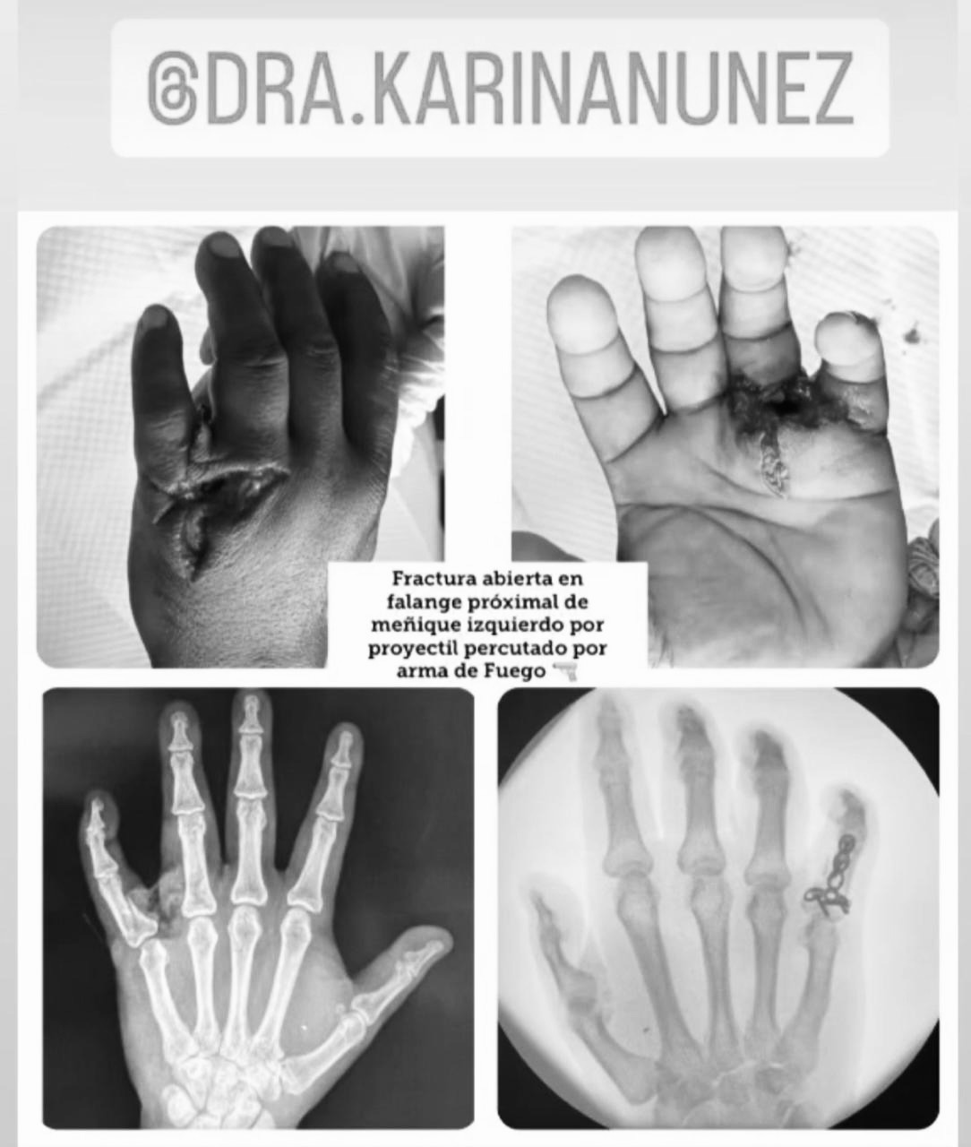 foto reemplazo